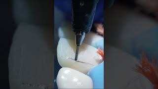 Mastering direct restoration of anterior teeth DentalEducation AnteriorRestoration [upl. by Dleifxam]