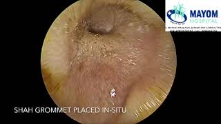 Glue Ear Otitis Media with Effusion  Treatment by Myringotomy Grommet Insertion  Dr Manish Prakash [upl. by Arracot480]