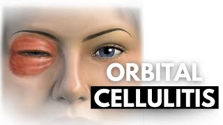 Orbital Cellulitis A Comprehensive Guide to Diagnosis and Management [upl. by Eerej]