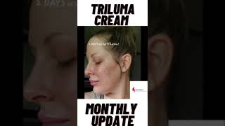 Tri Luma cream Before and After pictures [upl. by Madi]