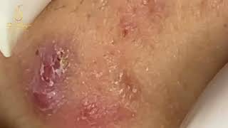 Loan Nguyen Acne Treatment 2212 [upl. by Melanie701]