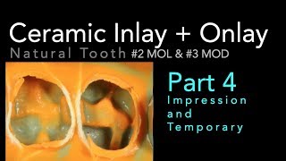 Lithium Disilicate Ceramics Part 4 Impression and Temporary [upl. by Namialus]