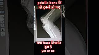 knee joint fracture xray youtuber youtubeshort youtubevideo [upl. by Kcirttap]