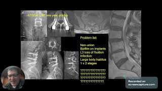 Spine Conference infected nonunion of the lumbar spine [upl. by Nednal]