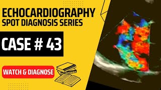 Echo Case 43 Echocardiography for beginners  Cardiology [upl. by Ellenohs]