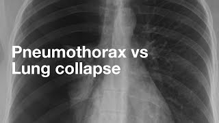 Pneumothorax vs Lung Collapse [upl. by Atikihs]