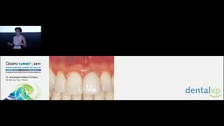 Peri Implant Mucositis Peri Implantitis Where Are We At [upl. by Peace]