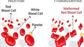 Thalassemia [upl. by Nangem]