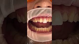 Veneers Process [upl. by Adnovad]