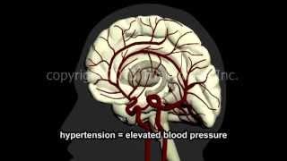 What Is A Stroke  Narration and Animation by Dr Cal Shipley MD [upl. by Denzil]