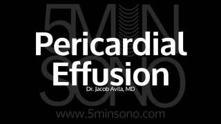 Pericardial effusion [upl. by Deegan628]