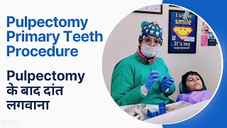 Pulpectomy Primary Teeth Procedure  Pulpectomy के बाद दांत लगवाना [upl. by Itsyrc]