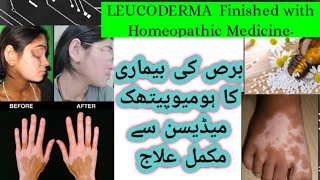 quotLeukoderma Leucoderma Treatment with homeopathic RemedyquotDoctor Abida [upl. by Barvick]