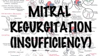 Mitral Reguritation insufficiency  Overview signs and symptoms pathophysiology treatment [upl. by Fleurette]