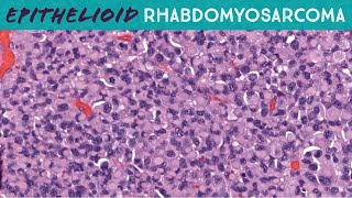 Epithelioid Rhabdomyosarcoma in Skin Emory case 4 rhabdoid cytology dermpath pathology dermatology [upl. by Volin]