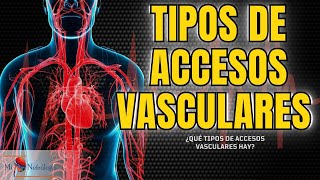 HemodiálisisTipos de accesos vasculares Experiencias de mis pacientes [upl. by Onaicilef]