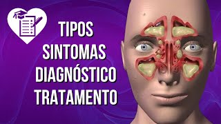 SINUSITE  Causas Sintomas e Tratamento [upl. by Tatiana409]