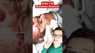 OMG Worst BLACKHEAD REMOVAL 2024  Fail shorts [upl. by Patnode550]