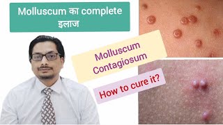 Molluscum Contagiosum Treatment  molluscum contagiosum removal  molluscum contagiosum in Hindi [upl. by Egiarc]