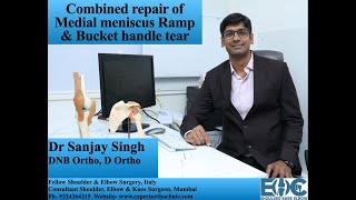 Cost effective repair of a Medial meniscus Ramp  Bucket handle tear [upl. by Rodmann603]