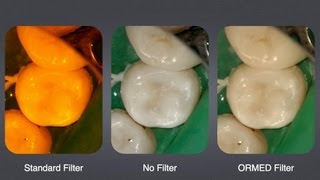 ORMED Filter Introduction  Optimal Light Source in Composite Restoration Short Version [upl. by Assilem]