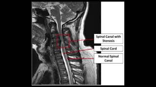 Spinal stenosis [upl. by Urania]