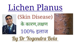 Lichen Planus  Skin Disease  के कारण लक्षण और 100 इलाज  By Dr Yogendra Bola [upl. by Retloc844]