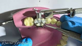 Class ll Amalgam Restoration  in Lower 6  Dr Rawan Medhat  شرح بالعربي [upl. by Sikorski]