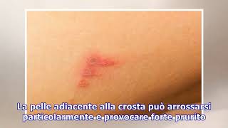 Impetigine come si prende e come si cura questa patologia della pelle [upl. by Eelannej]