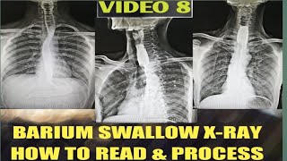 Barium Swallow Test  Barium Swallow Procedure [upl. by Katzen]