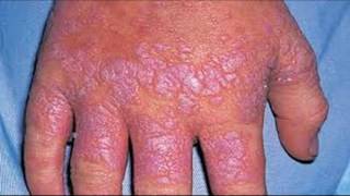 How To Treat And Cure Lichen Planus [upl. by Gnap694]