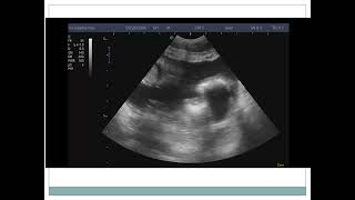 CASE 6 purulent peritonitis due to perforated appendicitis [upl. by Lou]