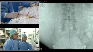 TCTAP 2018 Endovascular Symposium  Live Case Session IV [upl. by Tarah]