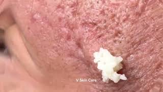 Remove ACNE FAST With These Treatment Secrets  V Skin Care part 169 [upl. by Nodal]