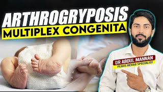 Understanding Arthrogryposis Multiplex Congenita Causes Symptoms and Treatment Options [upl. by Naima904]