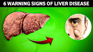 6 Warning Signs of Liver Disease [upl. by Irodim]