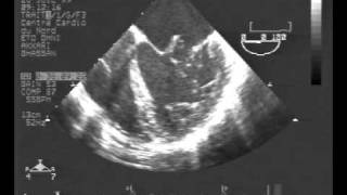 infective endocarditisTEE chordal rupture of both leaflets of the mitral valve [upl. by Coyle315]