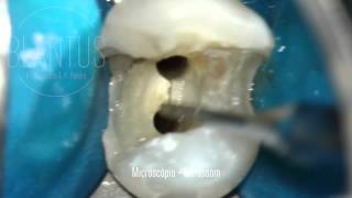 Microsonic in Endodontics [upl. by Afrikah602]