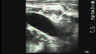 Ultrasoundguided axillary catheter insertion [upl. by Deckert]