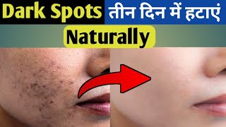 Dark Spots on Face Removal  Dark Spots kaise hataye  Dark Spots Removal [upl. by Downing]