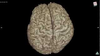 Variation of brain cortex 3D MRI sample Bgo [upl. by Maryl636]