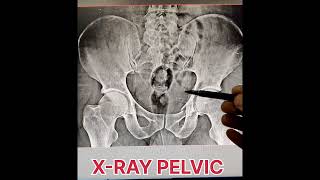 fracture of pubic rami radiology shortvideo [upl. by Ydnolem454]