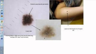 Dermoscopy Made Simple  Reed nevus [upl. by Xonk]