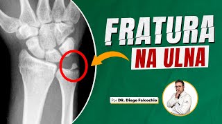 Fraturas da região distal da ulna [upl. by Alphonse]