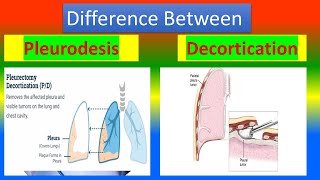 Difference between Pleurodesis and Decortication [upl. by Oderf]