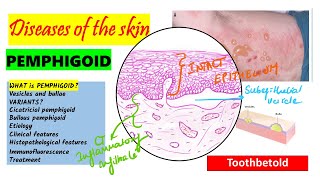 Pemphigoid Causes pathogenesis Types Histopathology Treatment  Pemphigus vs Pemphigoid [upl. by Nibur]