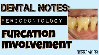 FURCATION INVOLVEMENT II DENTAL NOTES II STUDY WITH ME II PERIODONTOLOGY [upl. by Uhayile]