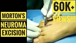 Mortons Neuroma Excision HD Detailed Surgical Video [upl. by Edialeda]