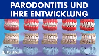 Zahnfleischentzündung Parodontitis und ihre Entwicklung © [upl. by Surat]