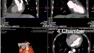 Coronary CT Angiography RCA Stenosis [upl. by Eiramaliehs]